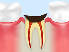 C4 歯の根の虫歯